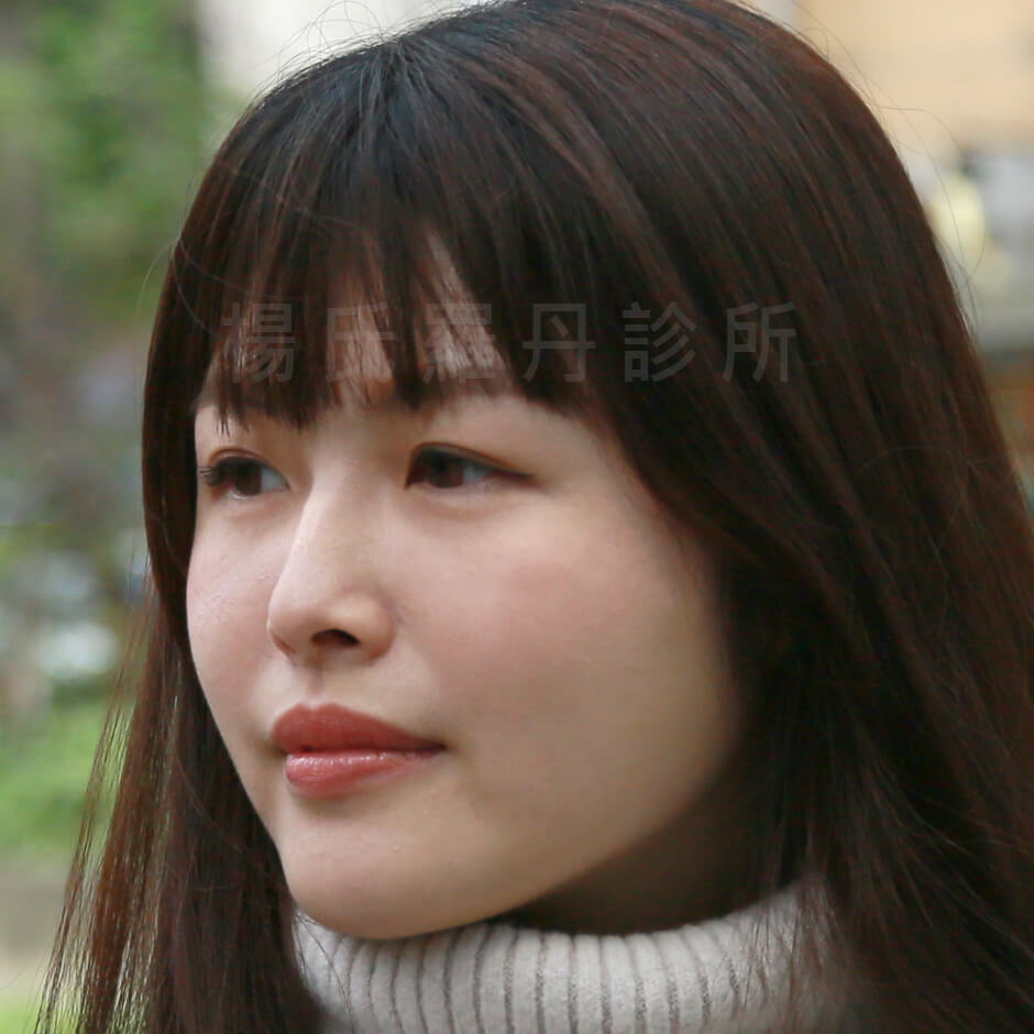 雷射減脂,瘦臉,楊氏羅丹，瘦下巴